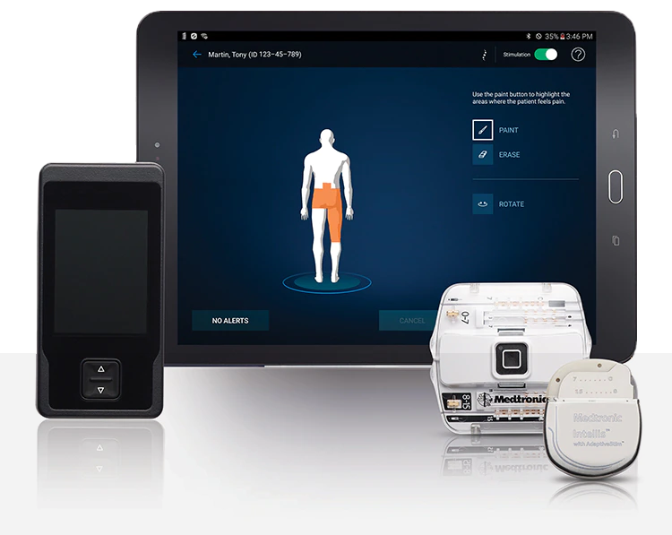 spinal cord stimulation