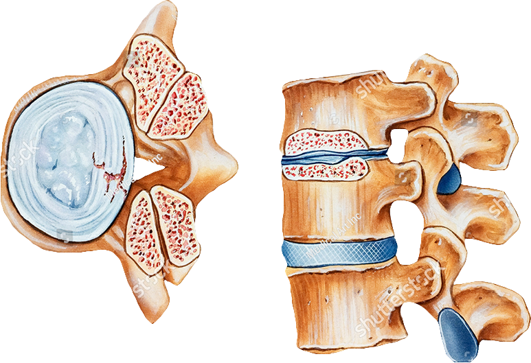 Spinal Stenosis