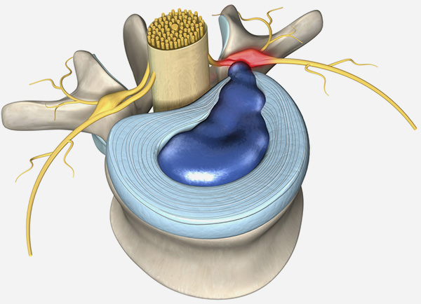 Disc Herniation