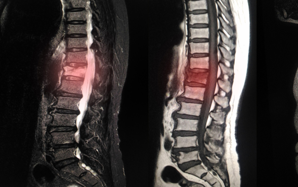 Degenerative Disc Disease Treatment