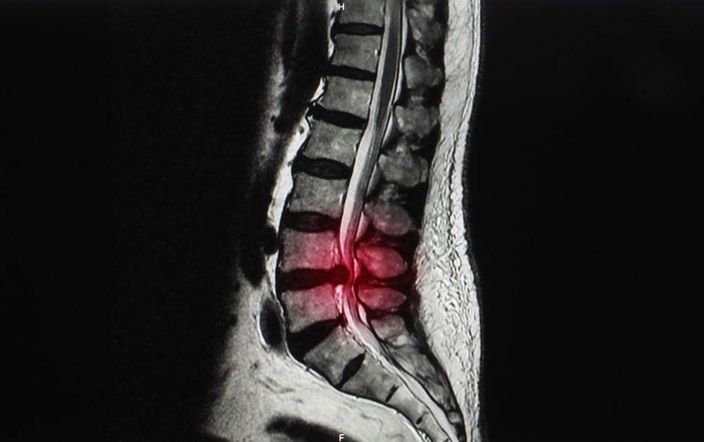 脊椎脊髄の手術 = Illustrated Surgery of Spine … Advancing Prone-Transpsoas Spine Surgery: A Narrative Review