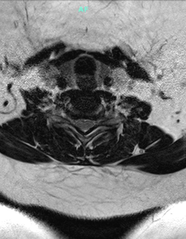 Pre op Bambou MRI Axial