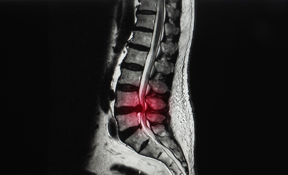 X-ray image of herniated disc