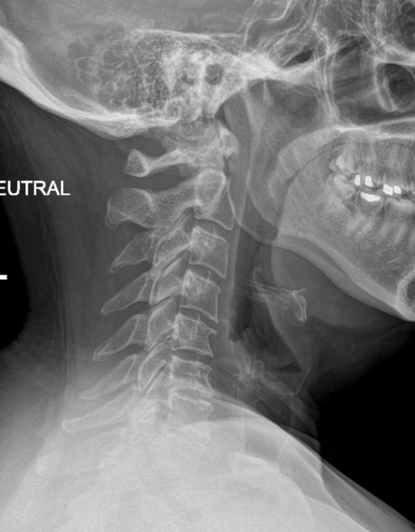 pre op Bambou lat x-ray