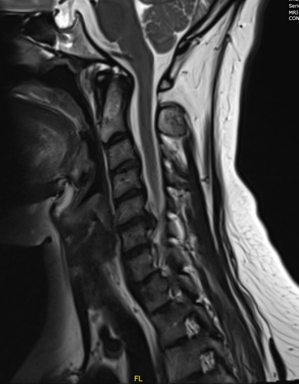 Waggoner Sagittal MRI Photo