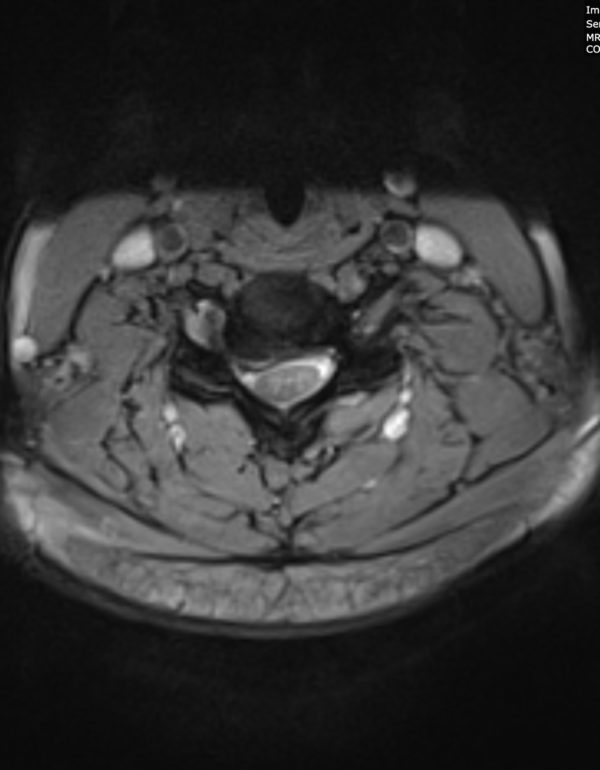 Wagonner Axial MRI