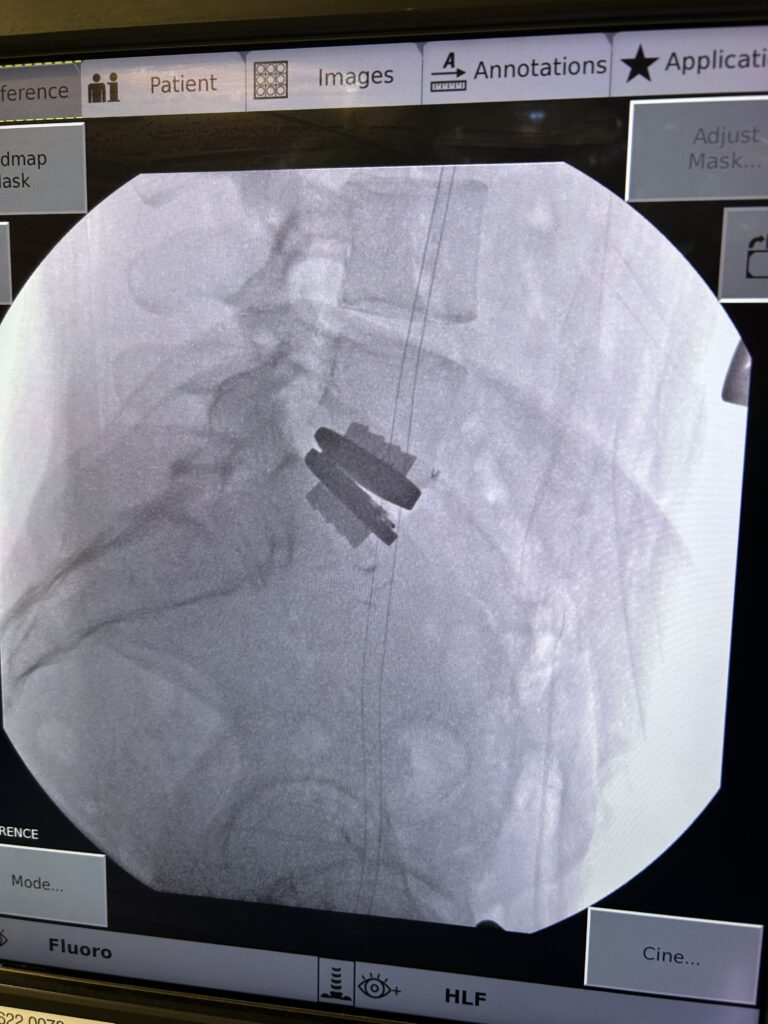 Illustration of lumbar spine anatomy showing disc replacement procedure