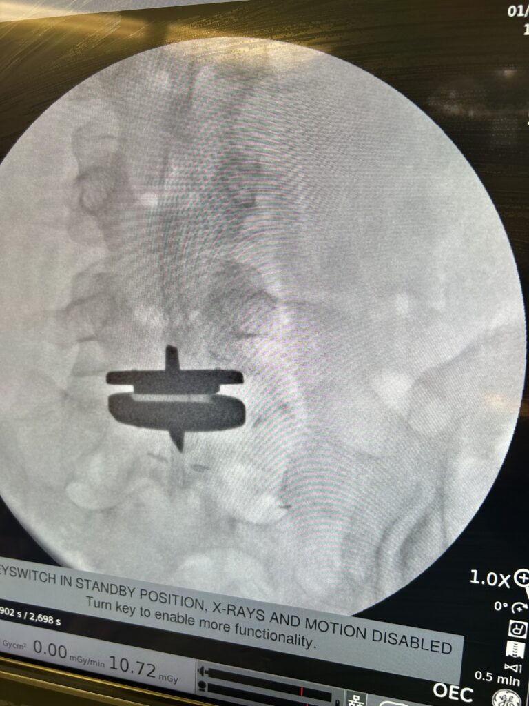 Illustration of lumbar spine anatomy showing disc replacement procedure